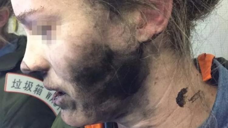 Patlayan Beats kulaklık kadının yüzünü yaktı