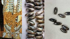 midesinden-uyusturcu-deposu-cikti