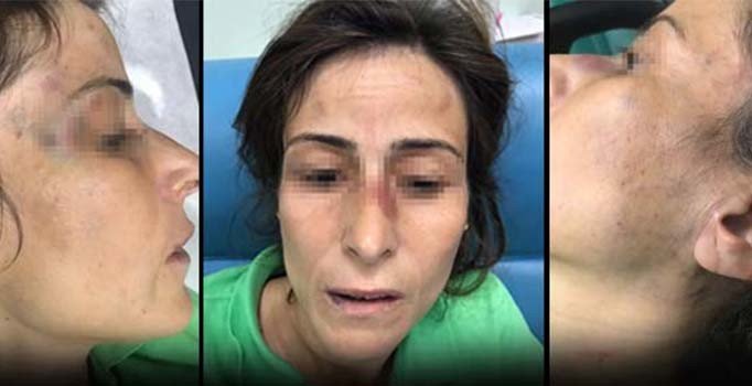 Eşinin kemiklerini kıran doktora çifte indirim