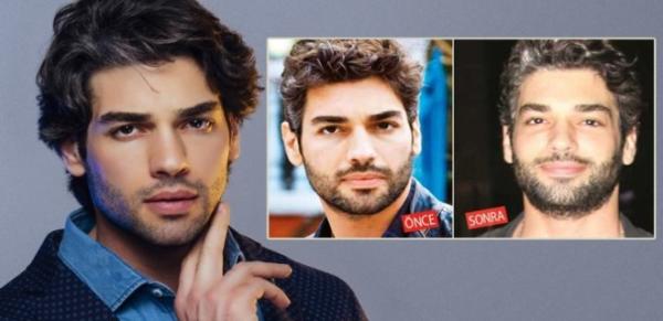 Şükrü Özyıldız 'Hollywood yanağı' yaptırdı