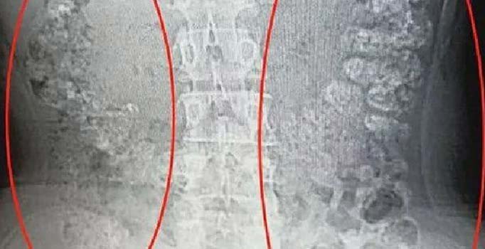 Türkiye’de de popüler olan soğuk içecek hastanelik etti